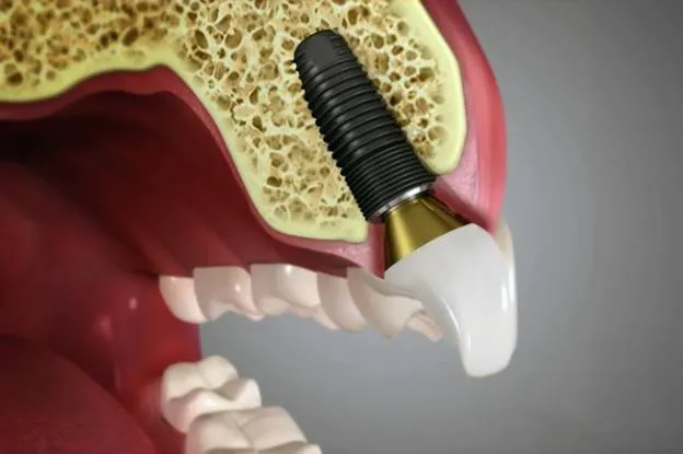 7 Signs You Might Need Dental Implants in San Francisco