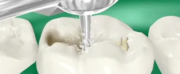 Choosing the Right Type of Teeth Filling | San Francisco