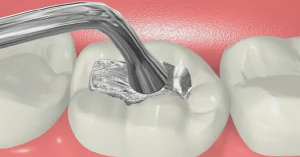 Composite vs. Amalgam Teeth Filling in San Francisco: Which is Better?