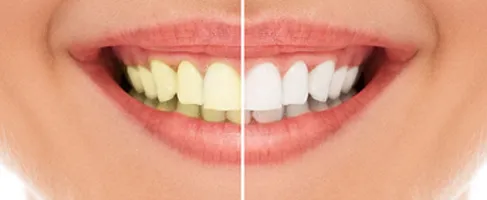 Is Teeth Whitening at The Dentist Permanent? | San Francisco