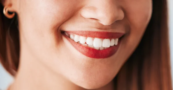 Myths You Should Know About Teeth Whitening in San Francisco