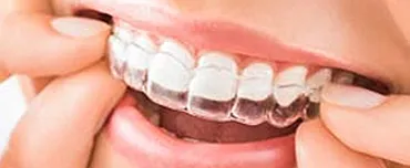Teeth Whitening While Wearing Invisalign | San Francisco, CA