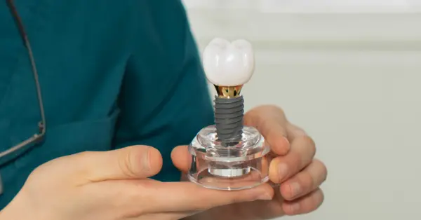 Helpful dental information about Dental Implants San Francisco