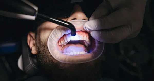 Will Teeth Whitening Work With Teeth Filling