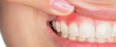 Will TMJ Affect Teeth & Gums? | TMJ Treatment San Francisco