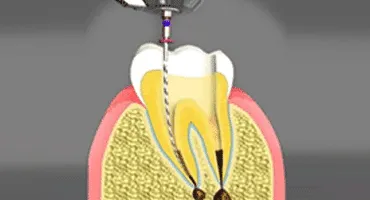 Endodontist in San Francisco